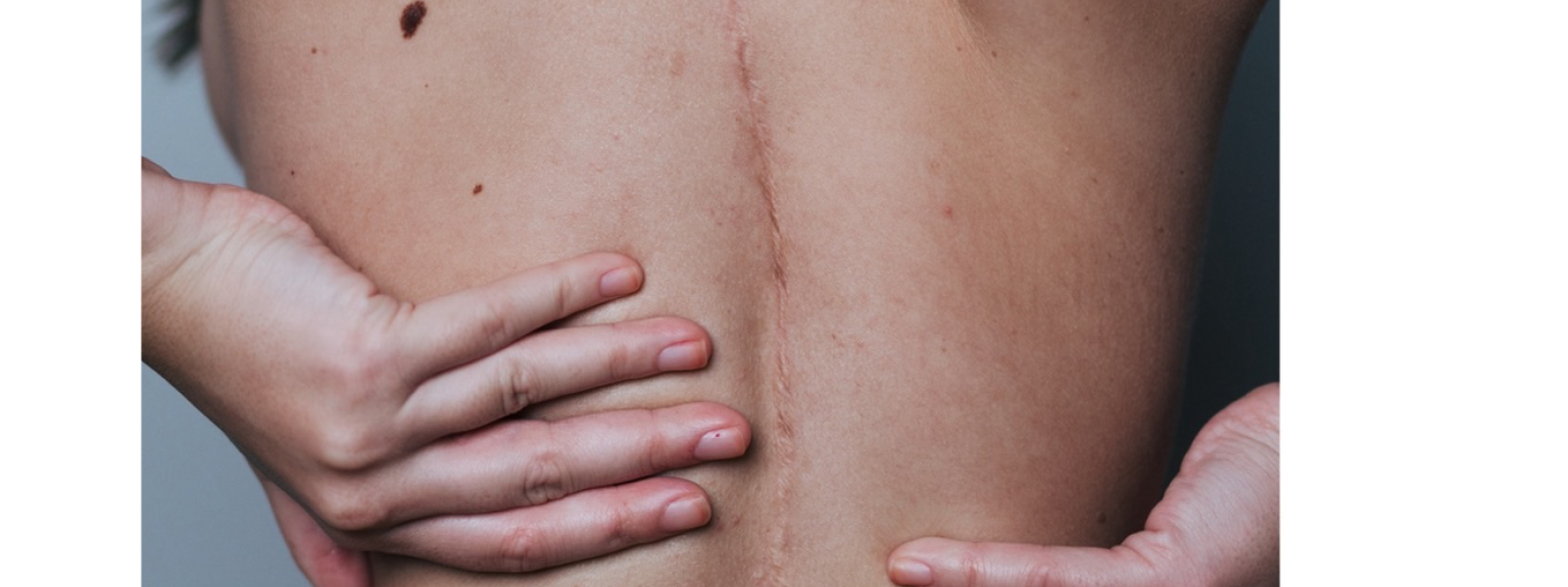 ISS Bone Reinforcement